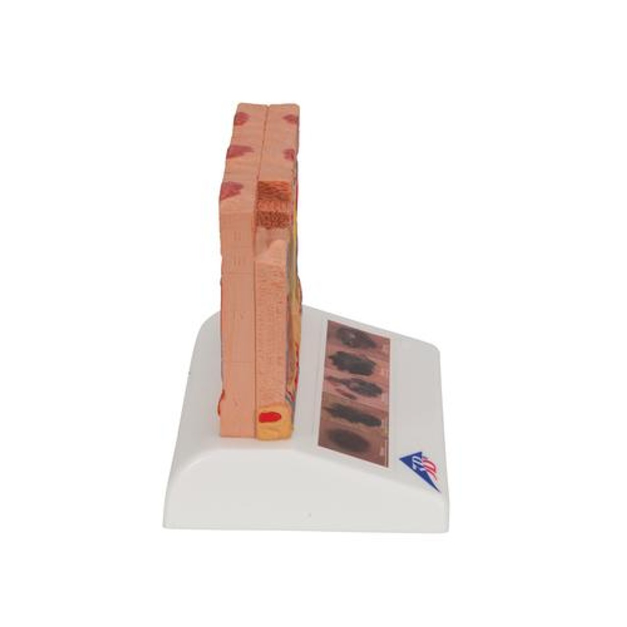 Skin Cancer Stages Model - Right Side View