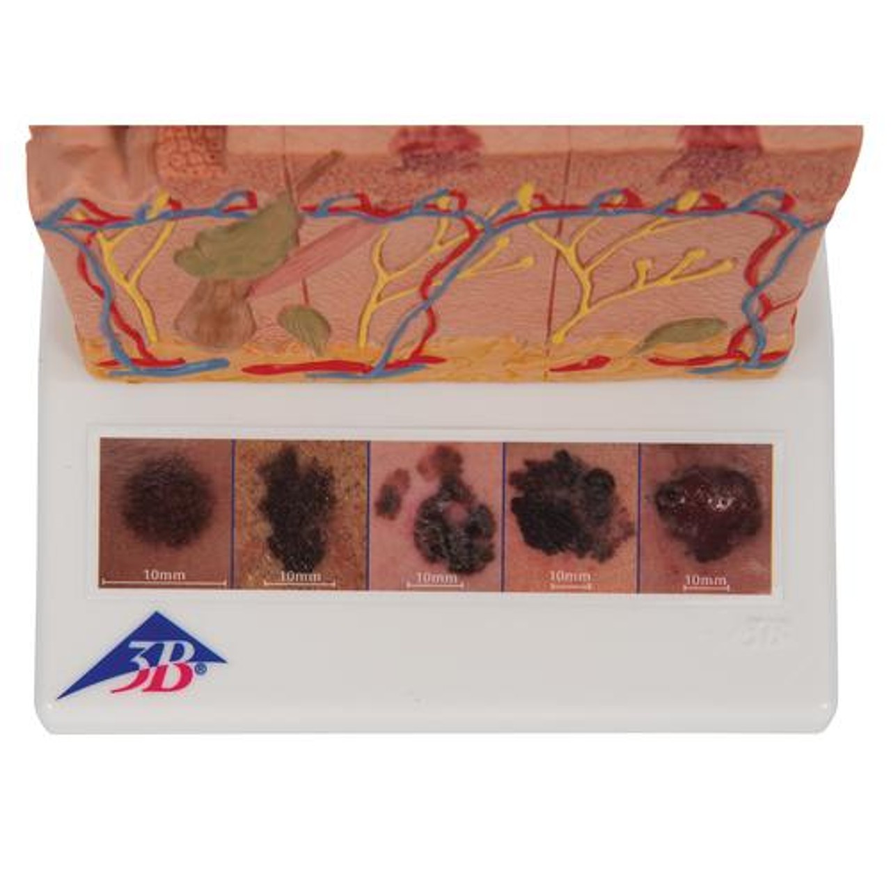 Skin Cancer Stages Model - Top View