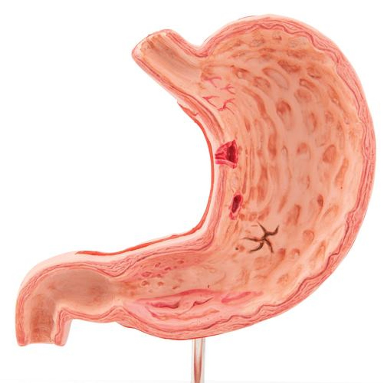 Stomach Anatomy Model With Ulcers