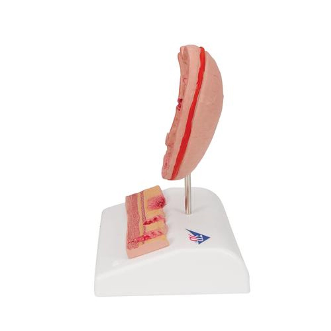 Stomach Anatomy Model With Ulcers