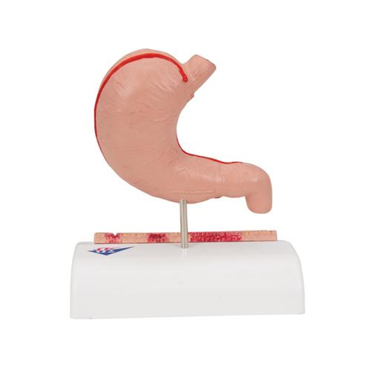 Stomach Anatomy Model With Ulcers