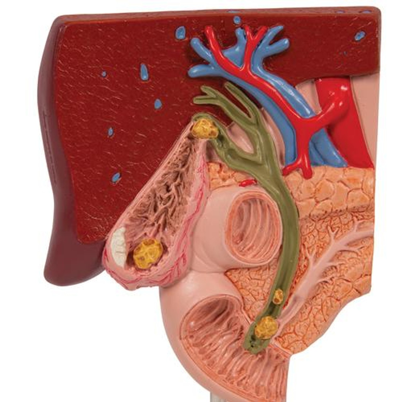 Gallstone Anatomy Model