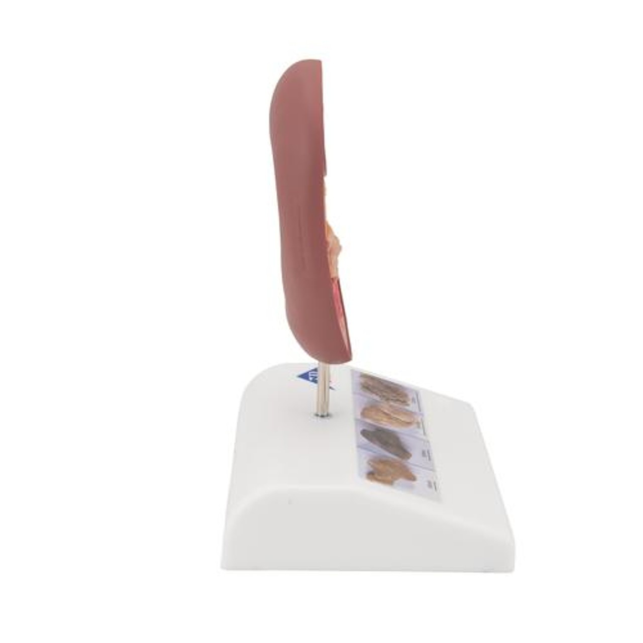 Kidney Stone Anatomy Model - Right Side View