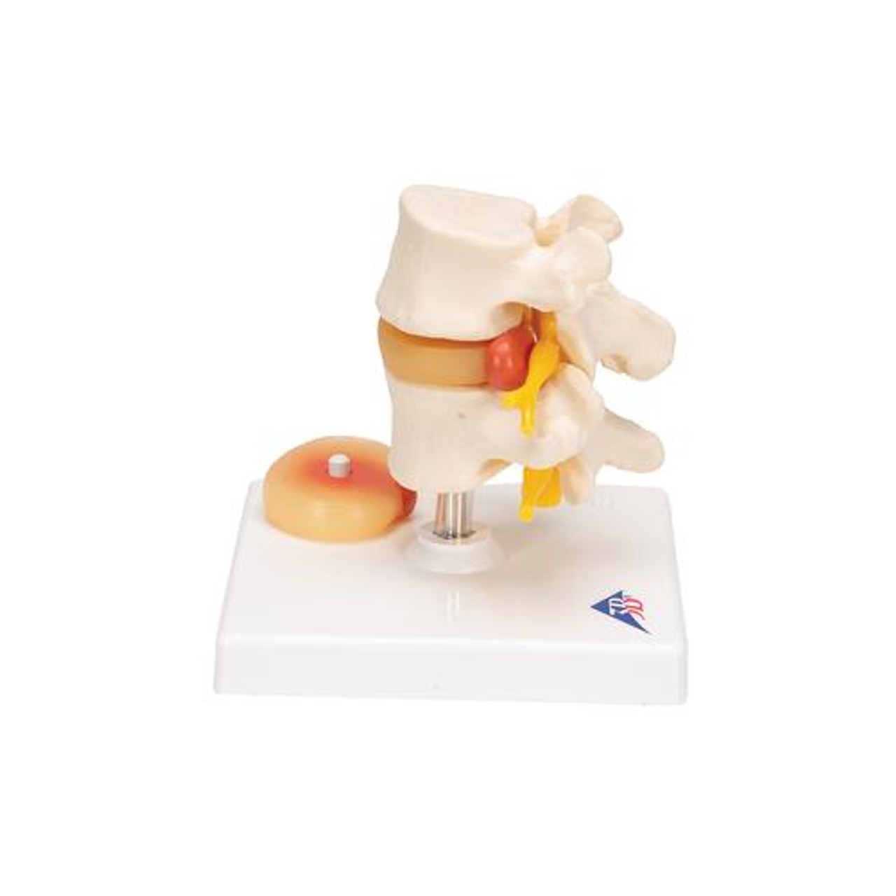 Lumbar Spinal Column Anatomy Model With Prolapsed Intervertebral Disc