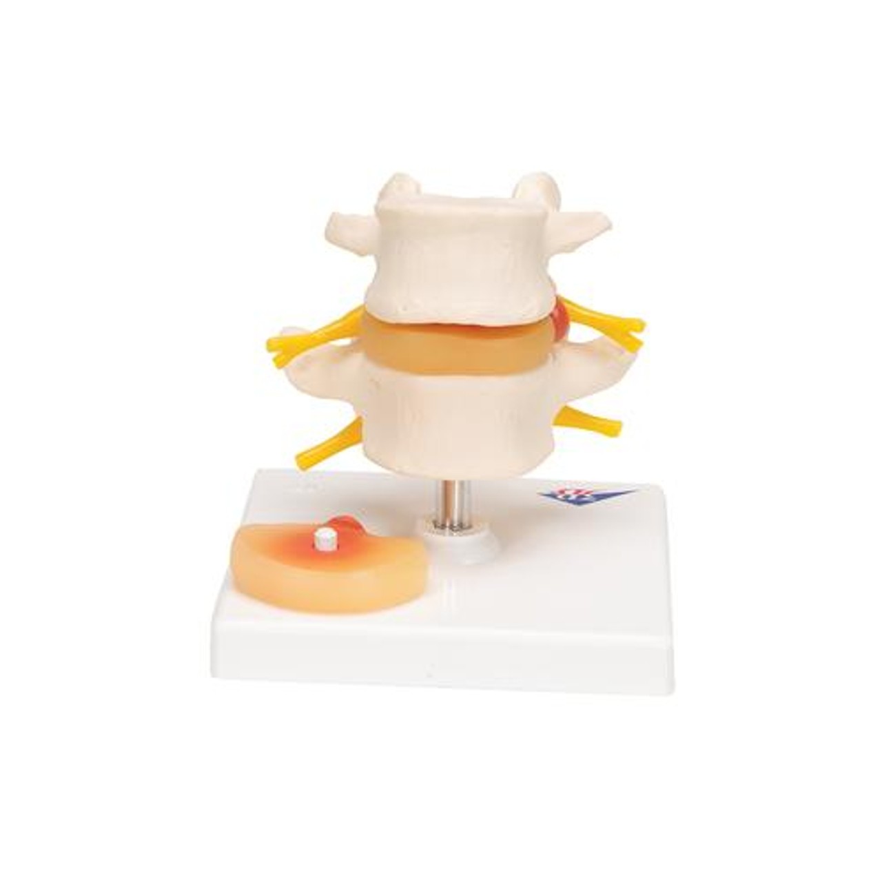 Lumbar Spinal Column Anatomy Model With Prolapsed Intervertebral Disc