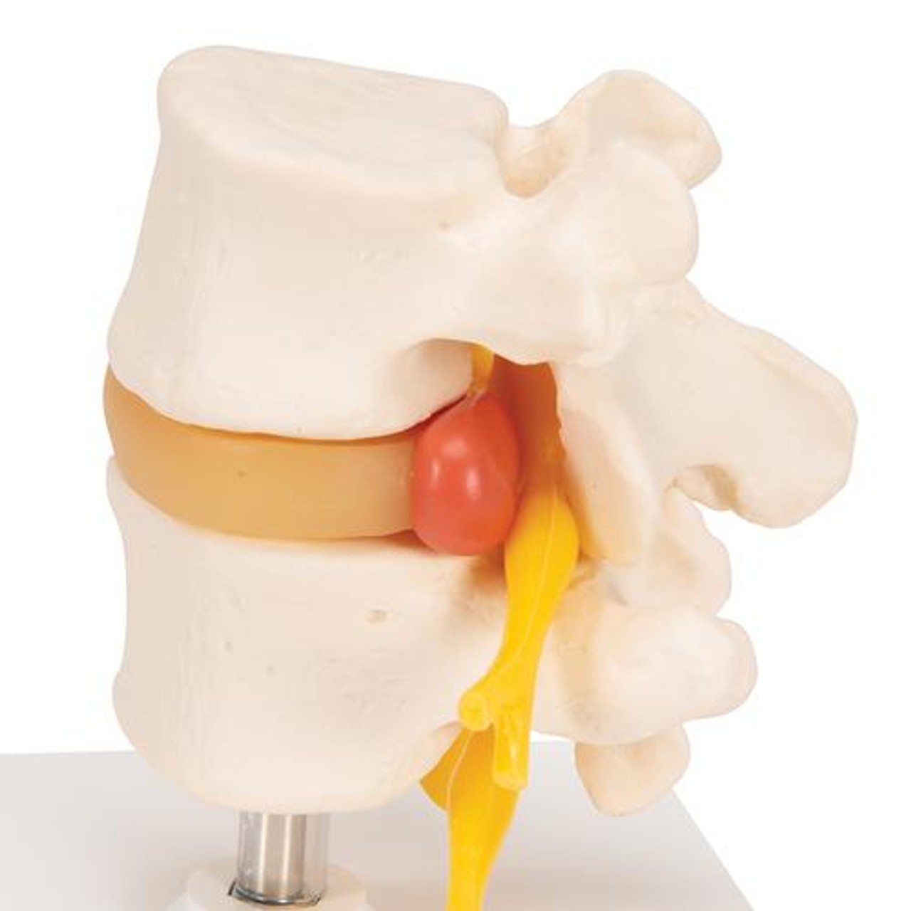 Lumbar Spinal Column Anatomy Model With Prolapsed Intervertebral Disc