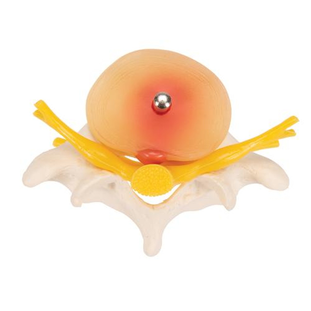 Lumbar Spinal Column Anatomy Model With Prolapsed Intervertebral Disc