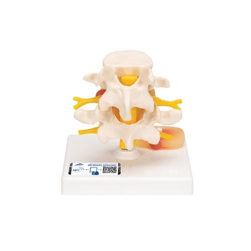 3B Scientific Lumbar Spinal Column Anatomy Model With Prolapsed