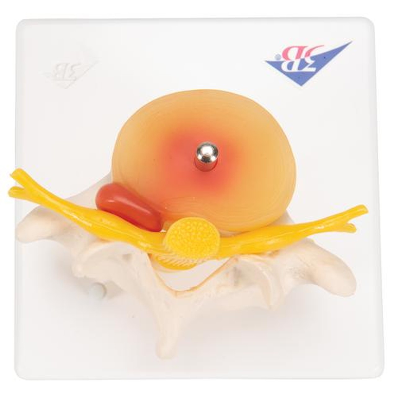 Lumbar Spinal Column Anatomy Model With Prolapsed Intervertebral Disc