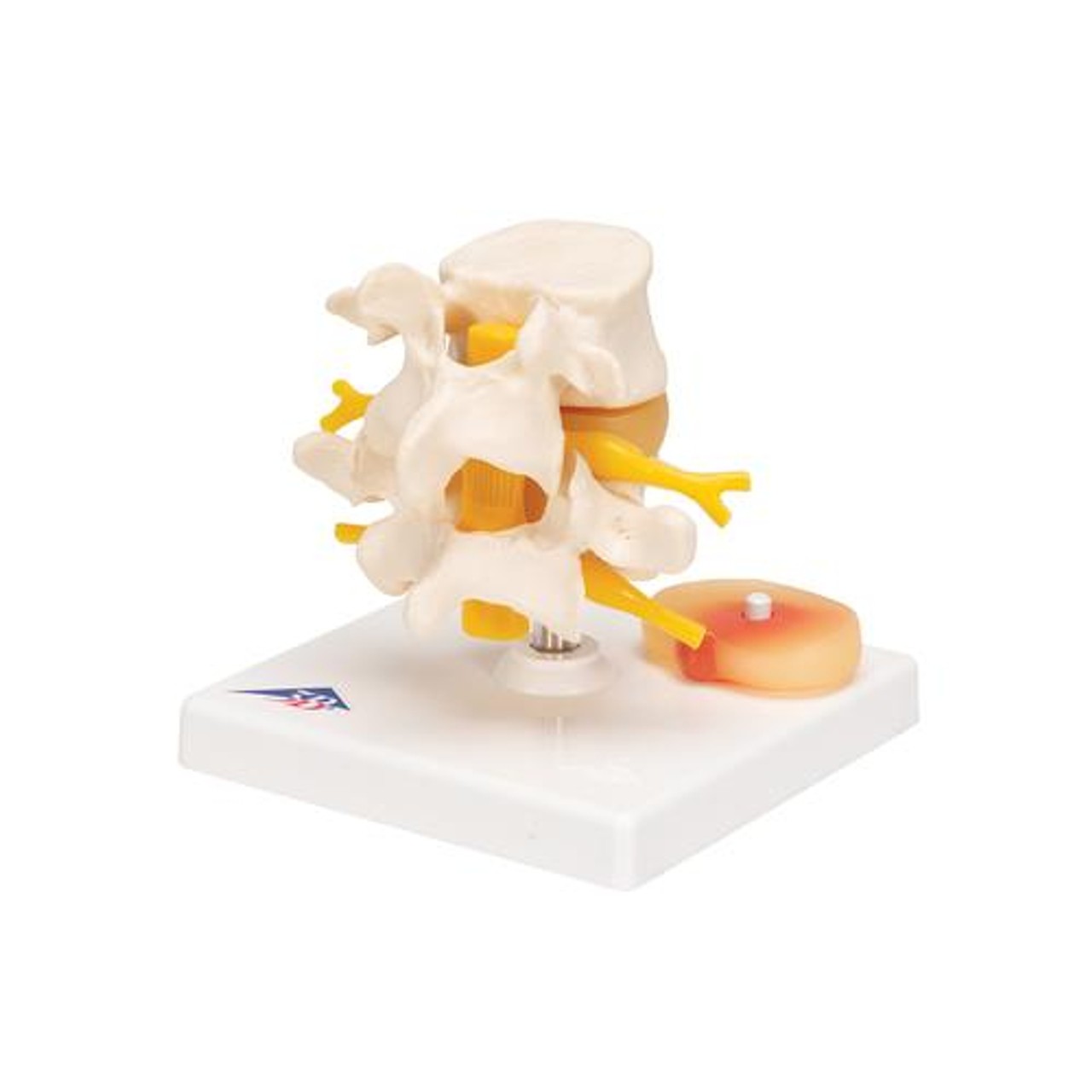 Lumbar Spinal Column Anatomy Model With Prolapsed Intervertebral Disc