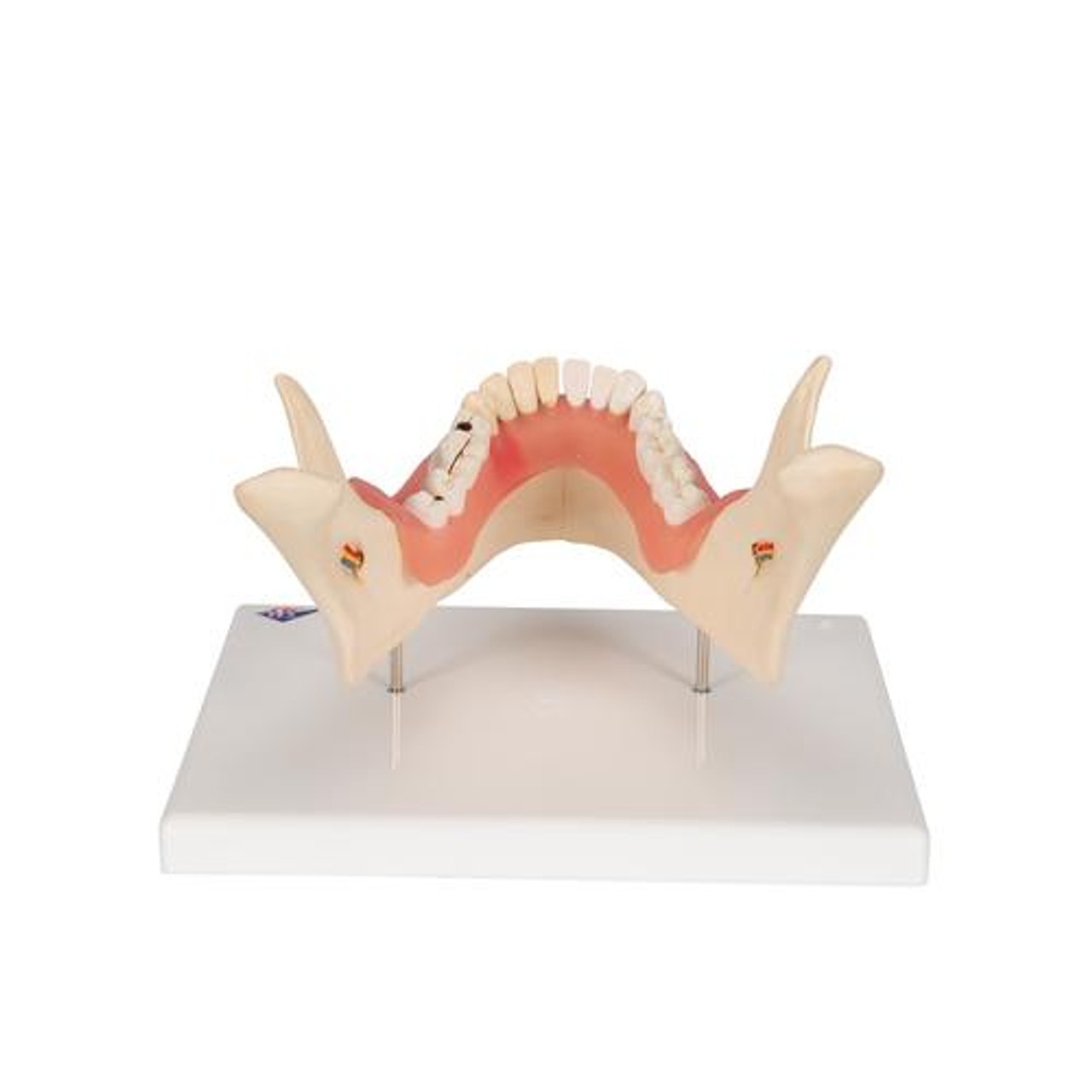 Dental Disease Model Lower Jaw