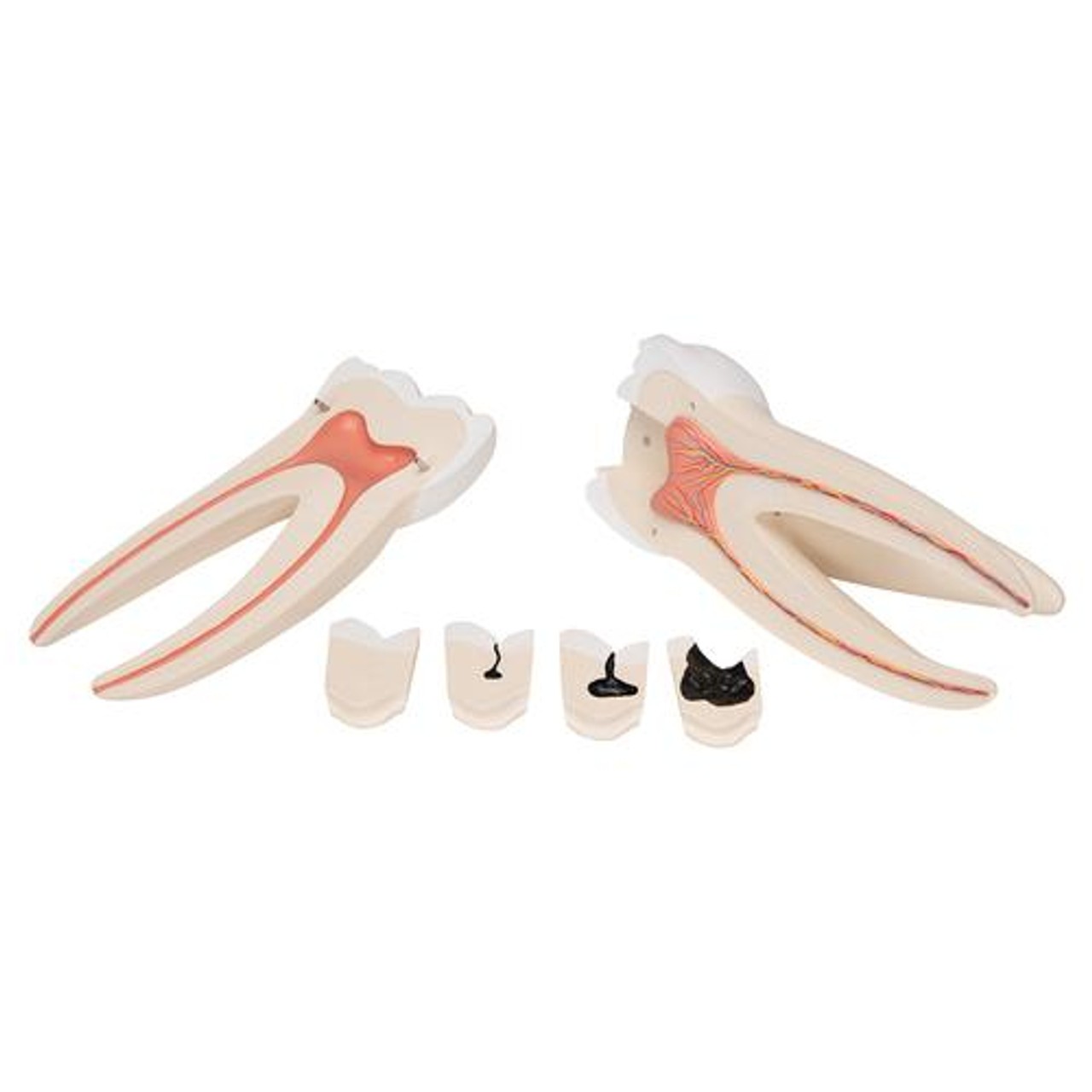 Giant Molar Anatomy Model With Dental Caries