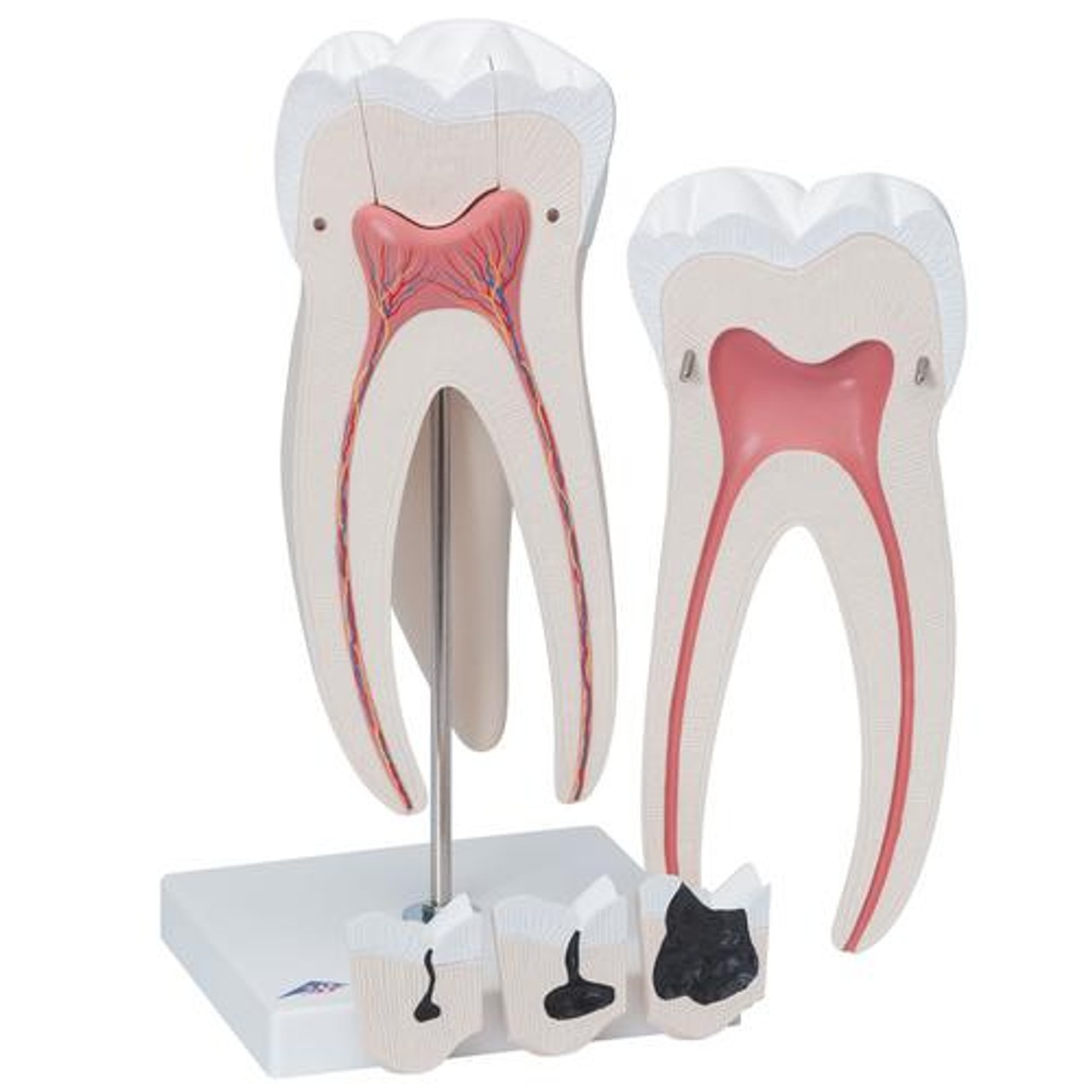 Giant Molar Anatomy Model With Dental Caries