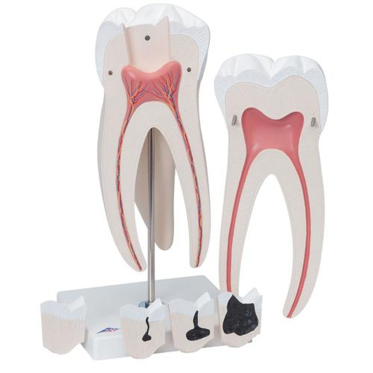 Giant Molar Anatomy Model With Dental Caries