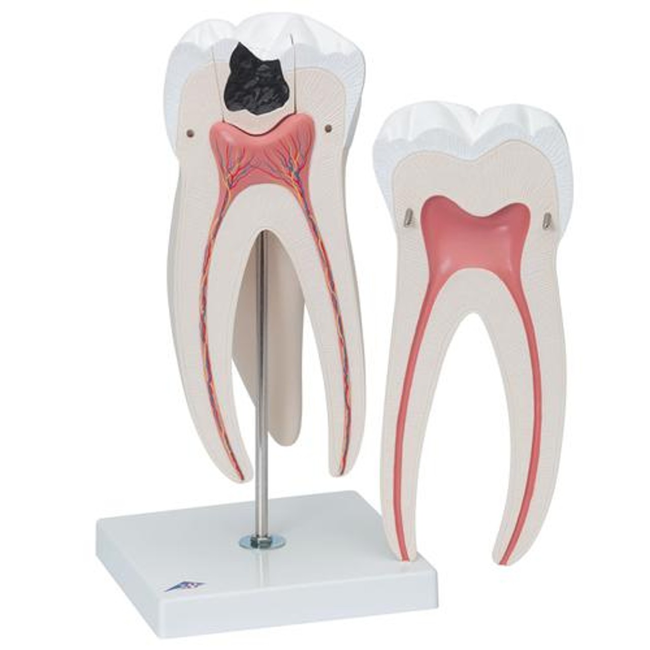 Giant Molar Anatomy Model With Dental Caries