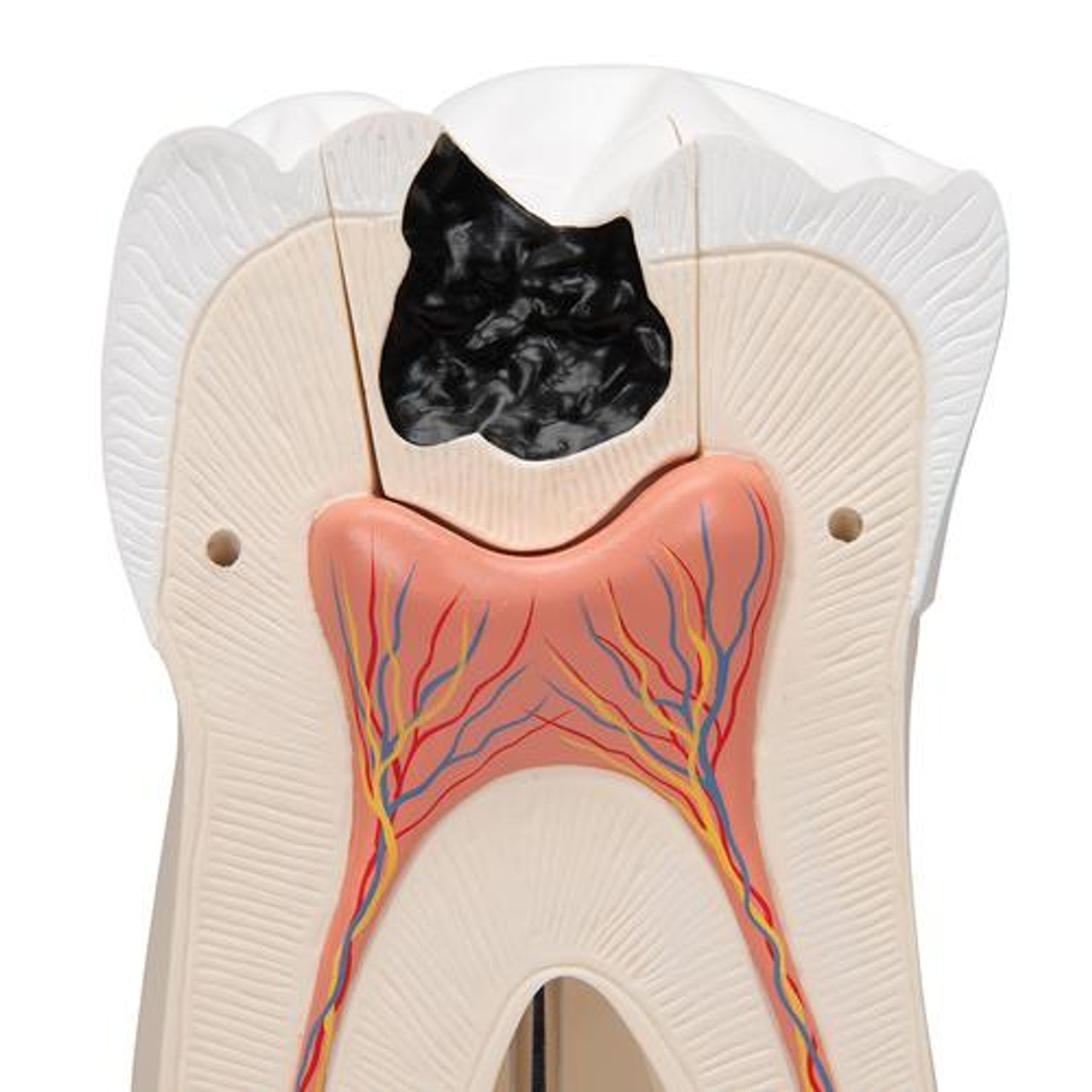 Giant Molar Anatomy Model With Dental Caries