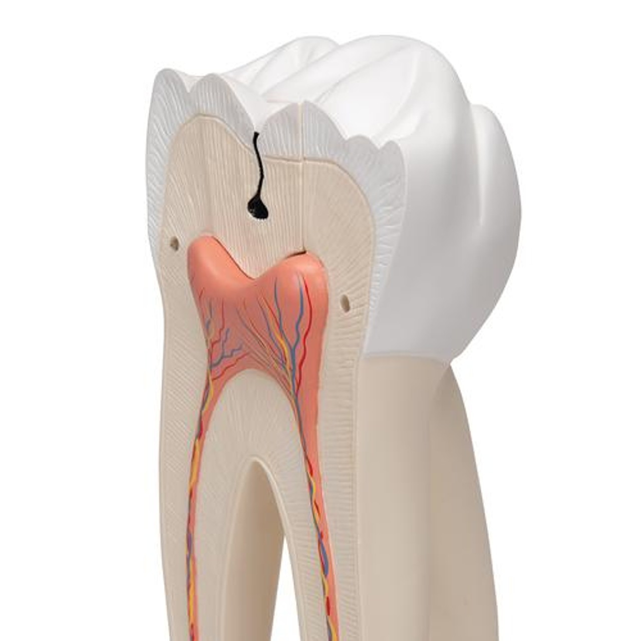 Giant Molar Anatomy Model With Dental Caries