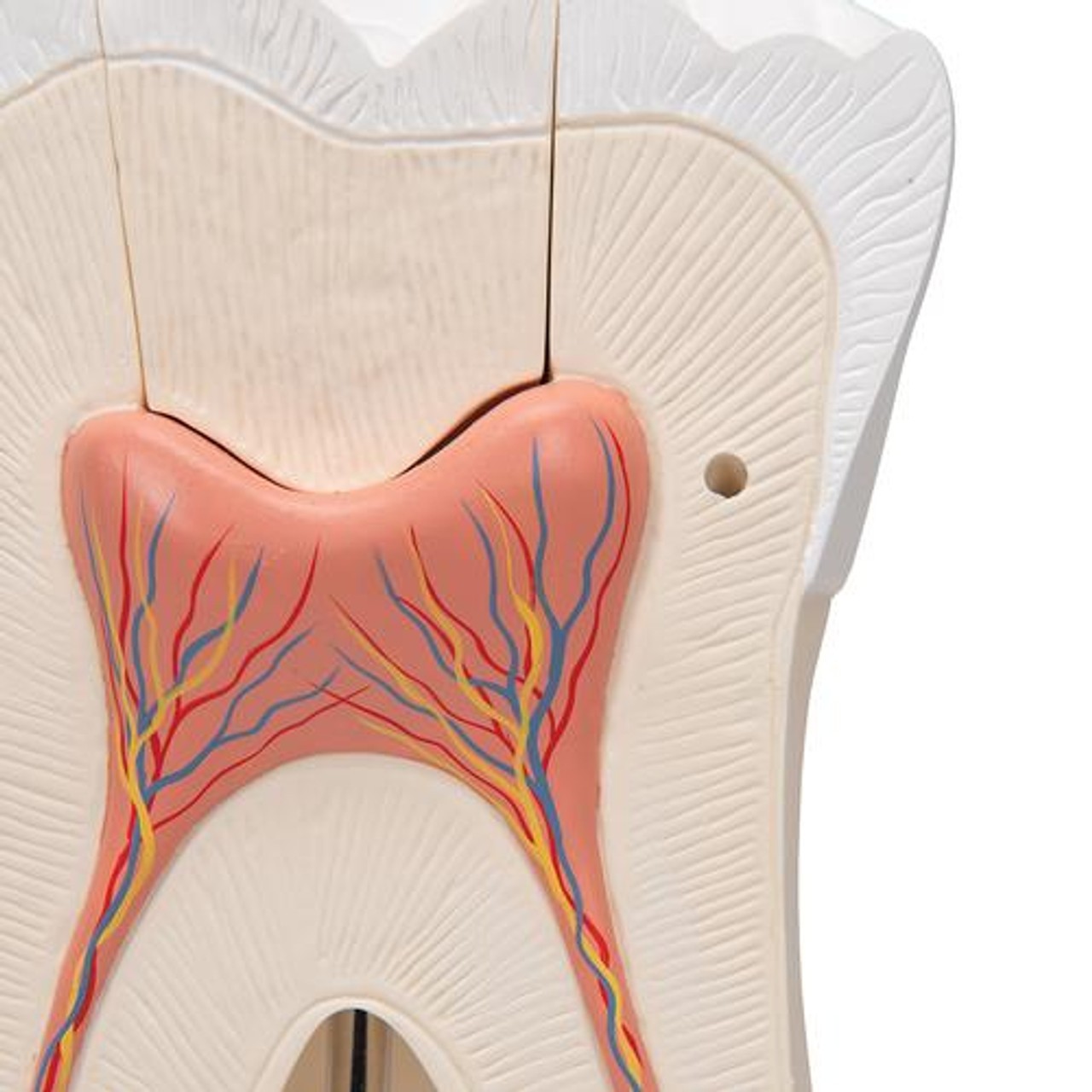 Giant Molar Anatomy Model With Dental Caries