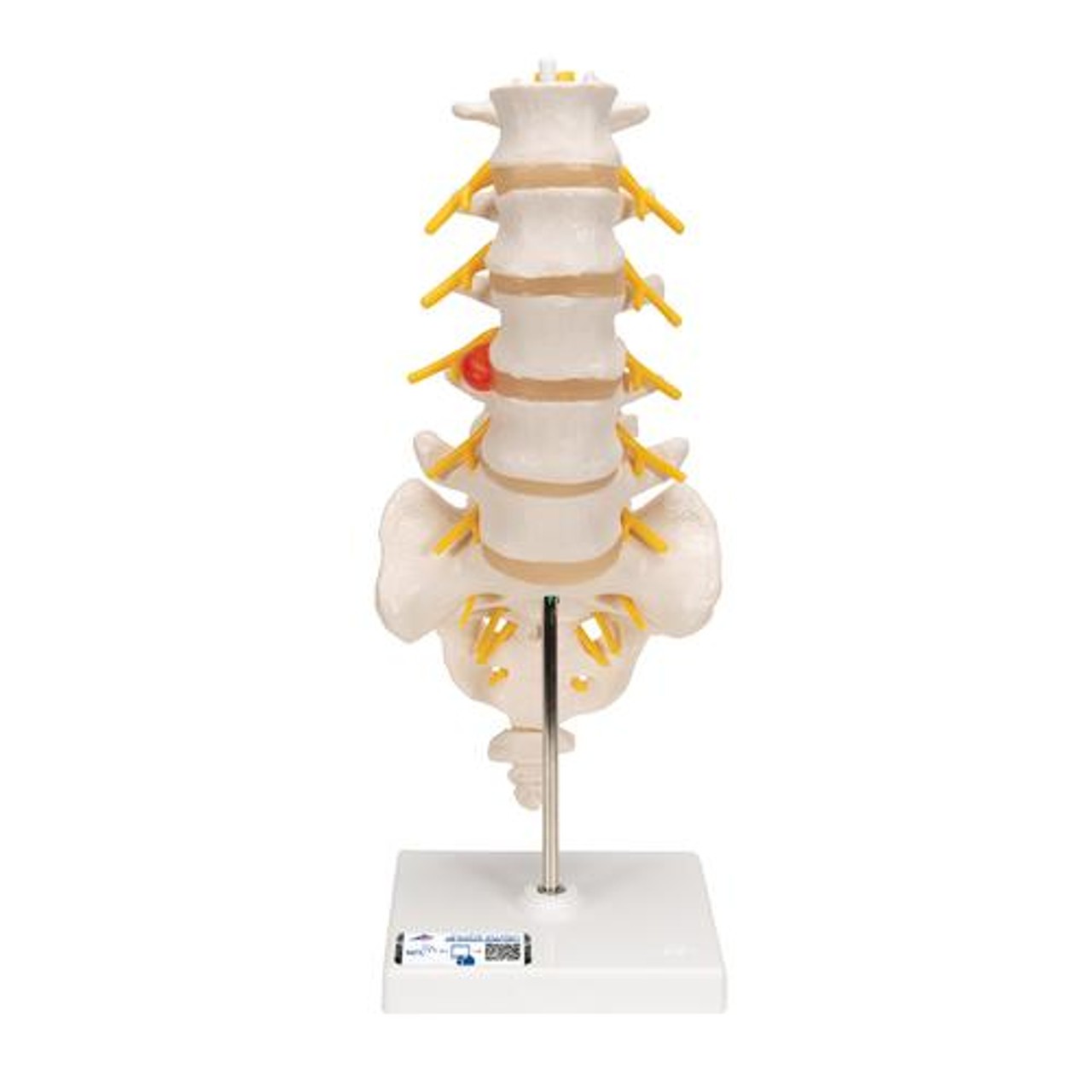 Lumbar Spinal Column Anatomy Model With Dorso-Lateral Prolapsed Intervertebral Disc