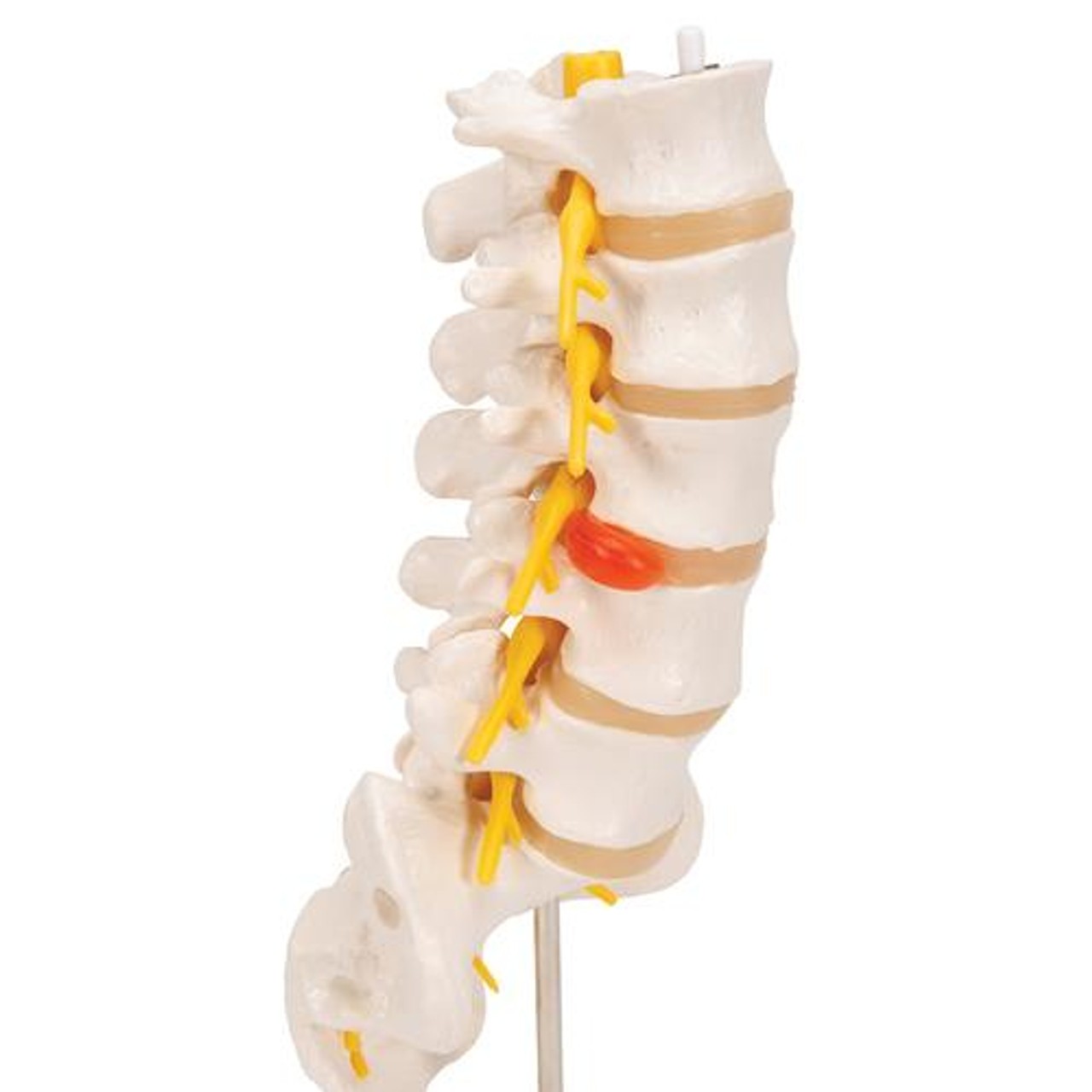 Lumbar Spinal Column Anatomy Model With Dorso-Lateral Prolapsed Intervertebral Disc