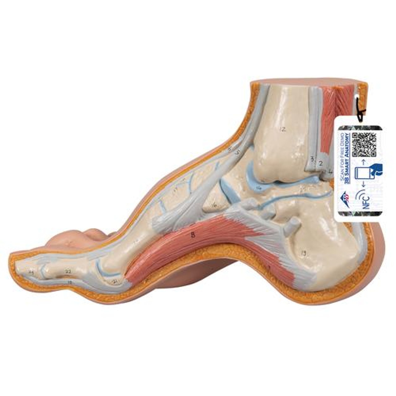 Hollow Foot Pes Cavus Anatomy Model