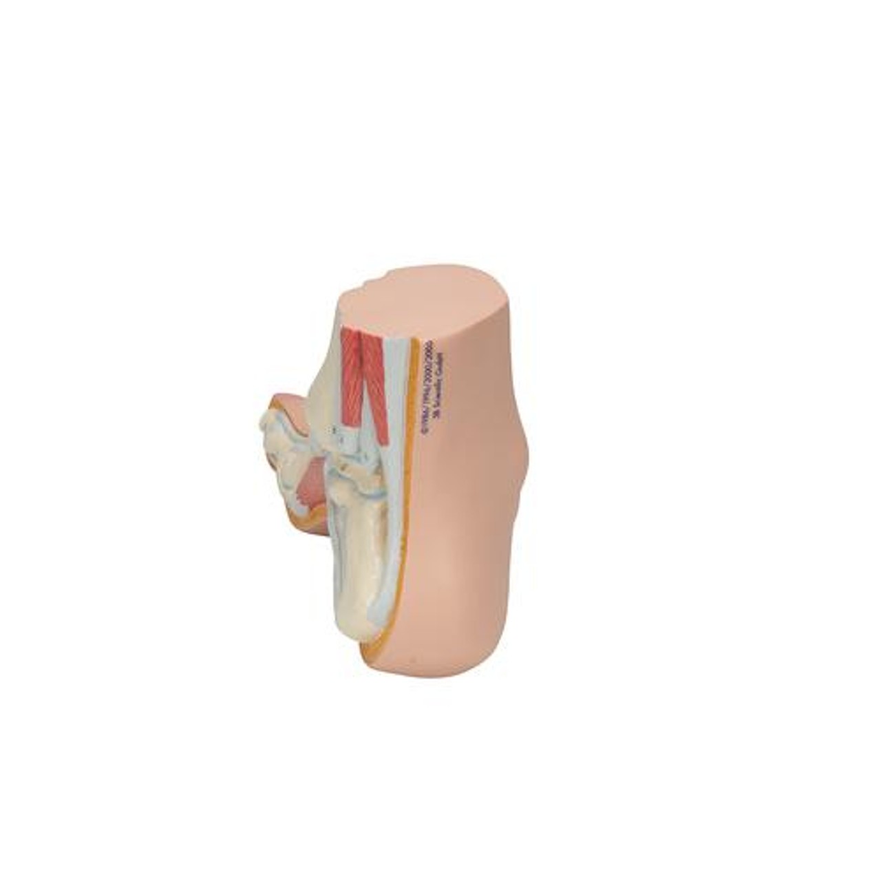 Hollow Foot Pes Cavus Anatomy Model - Back View