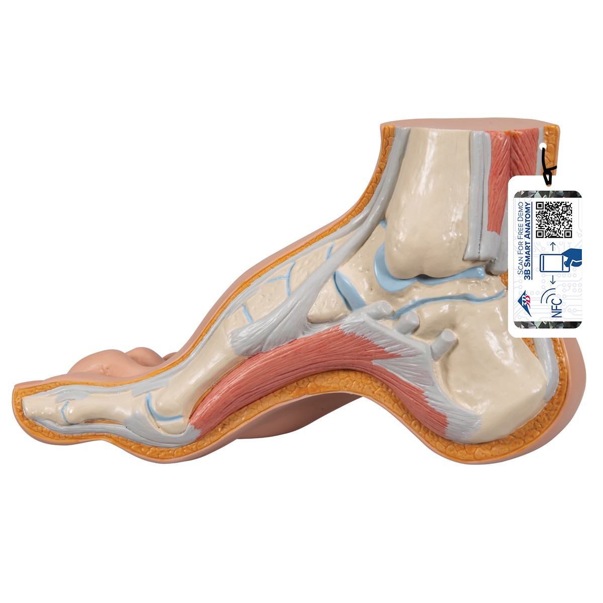 Hollow Foot Pes Cavus Anatomy Model