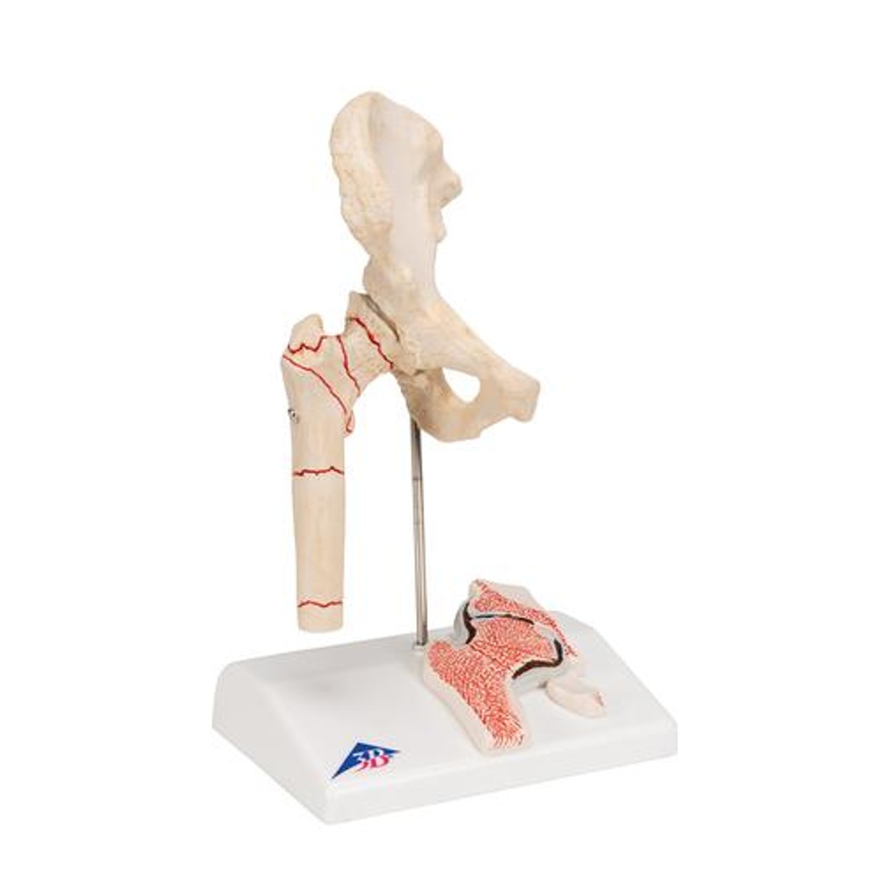 Femoral Fracture Anatomy Model - Right Side View