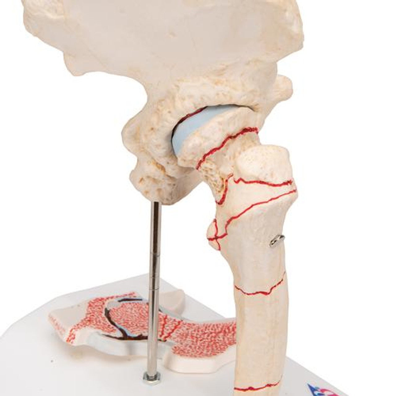 Femoral Fracture Anatomy Model - Detailed View