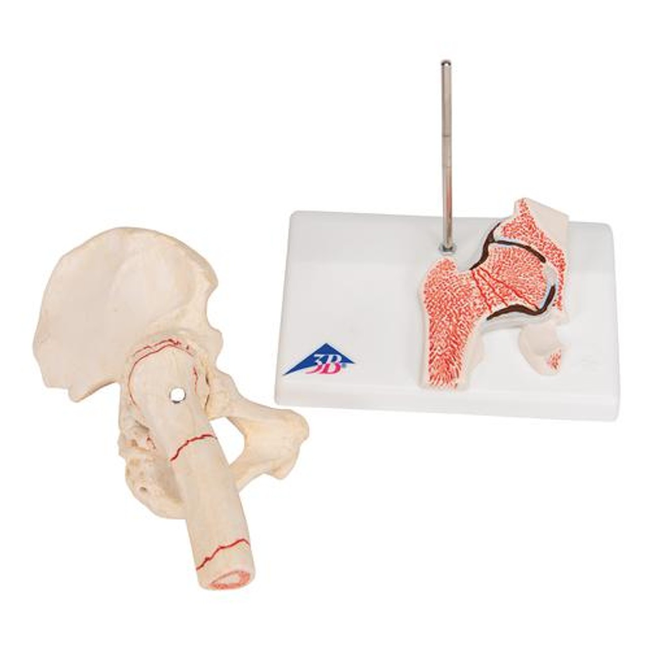 Femoral Fracture Anatomy Model