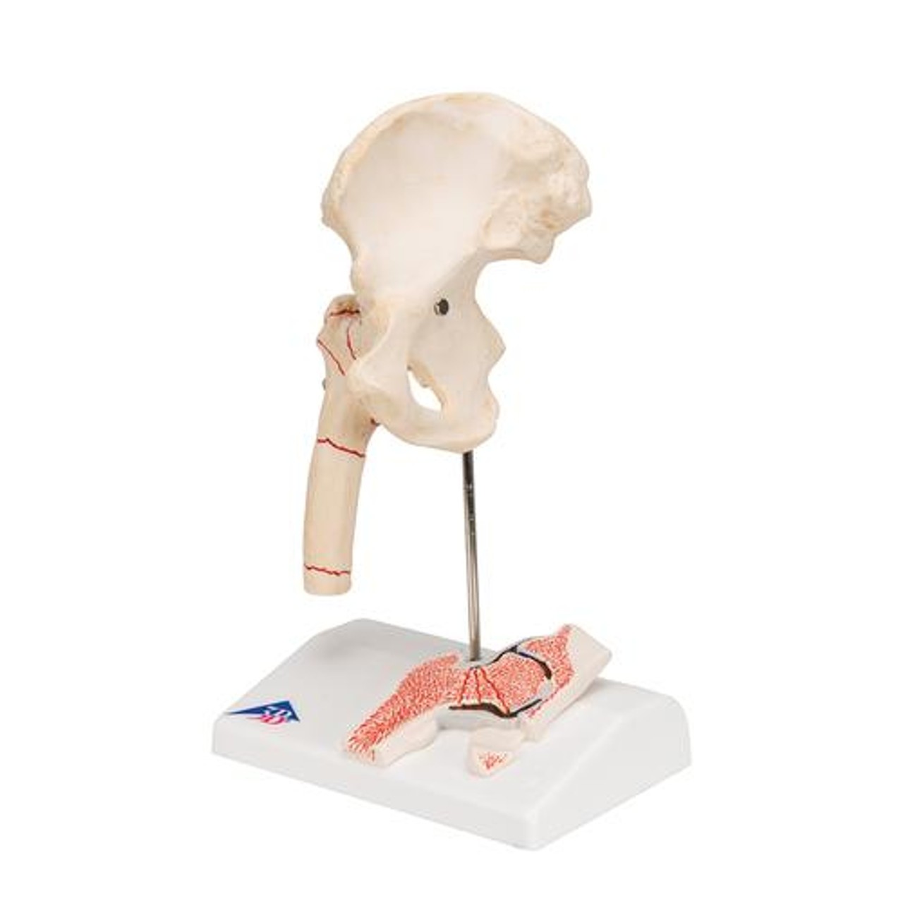 Femoral Fracture Anatomy Model - Left Side View