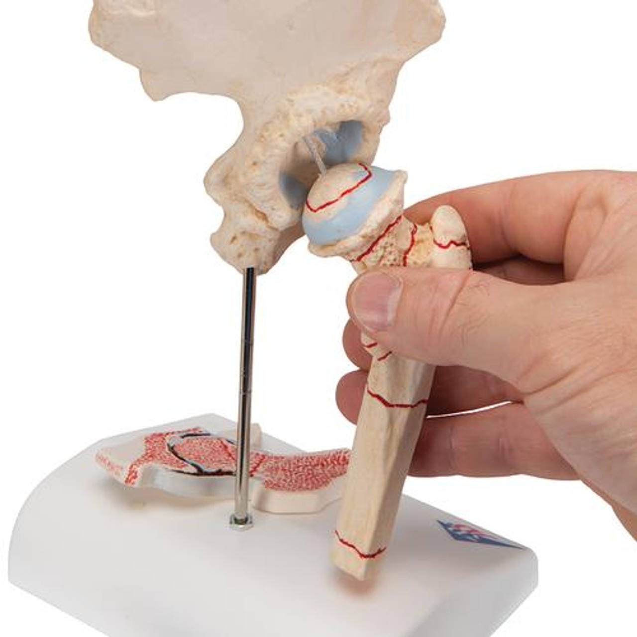 Femoral Fracture Anatomy Model - Detailed View