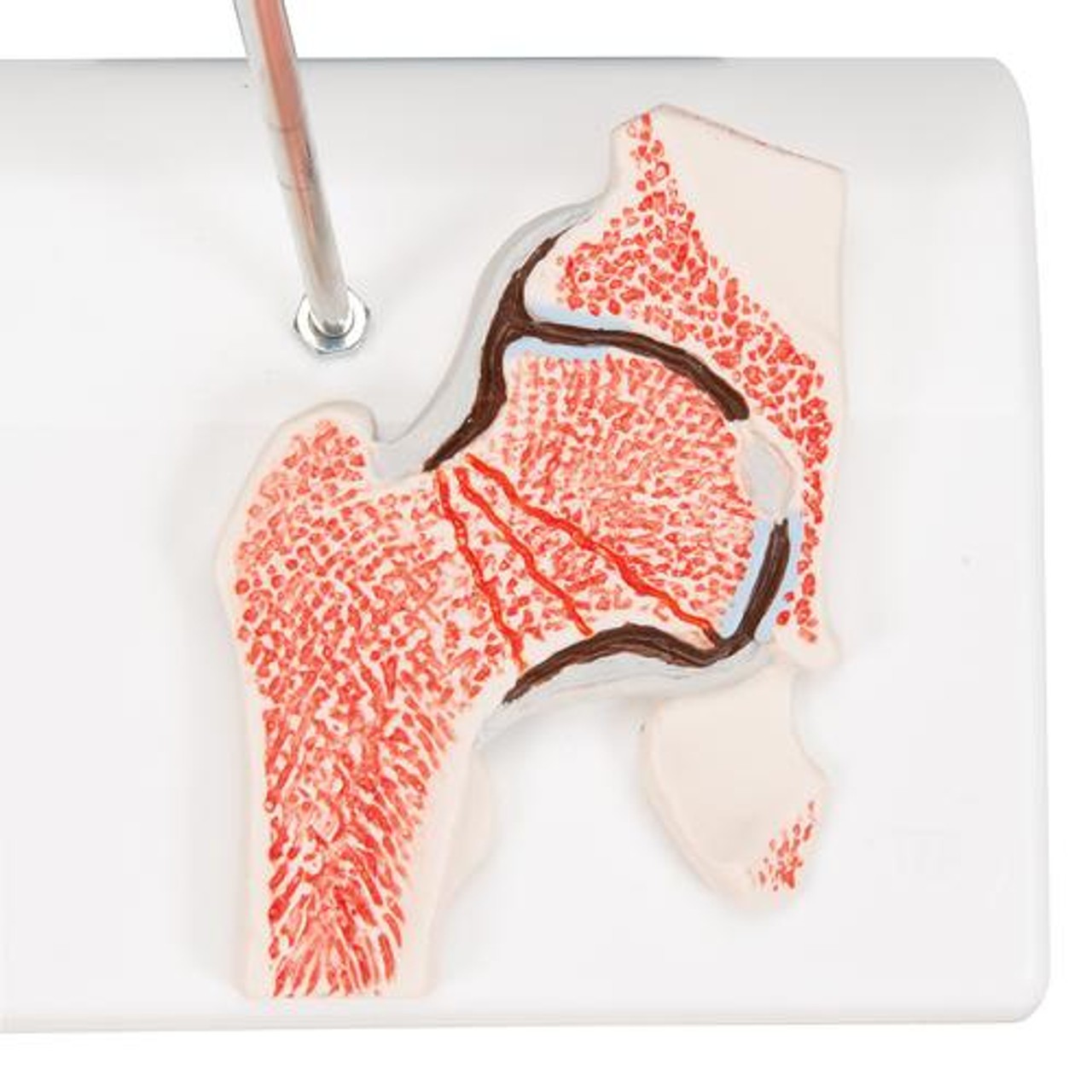 Femoral Fracture Anatomy Model - Detailed View