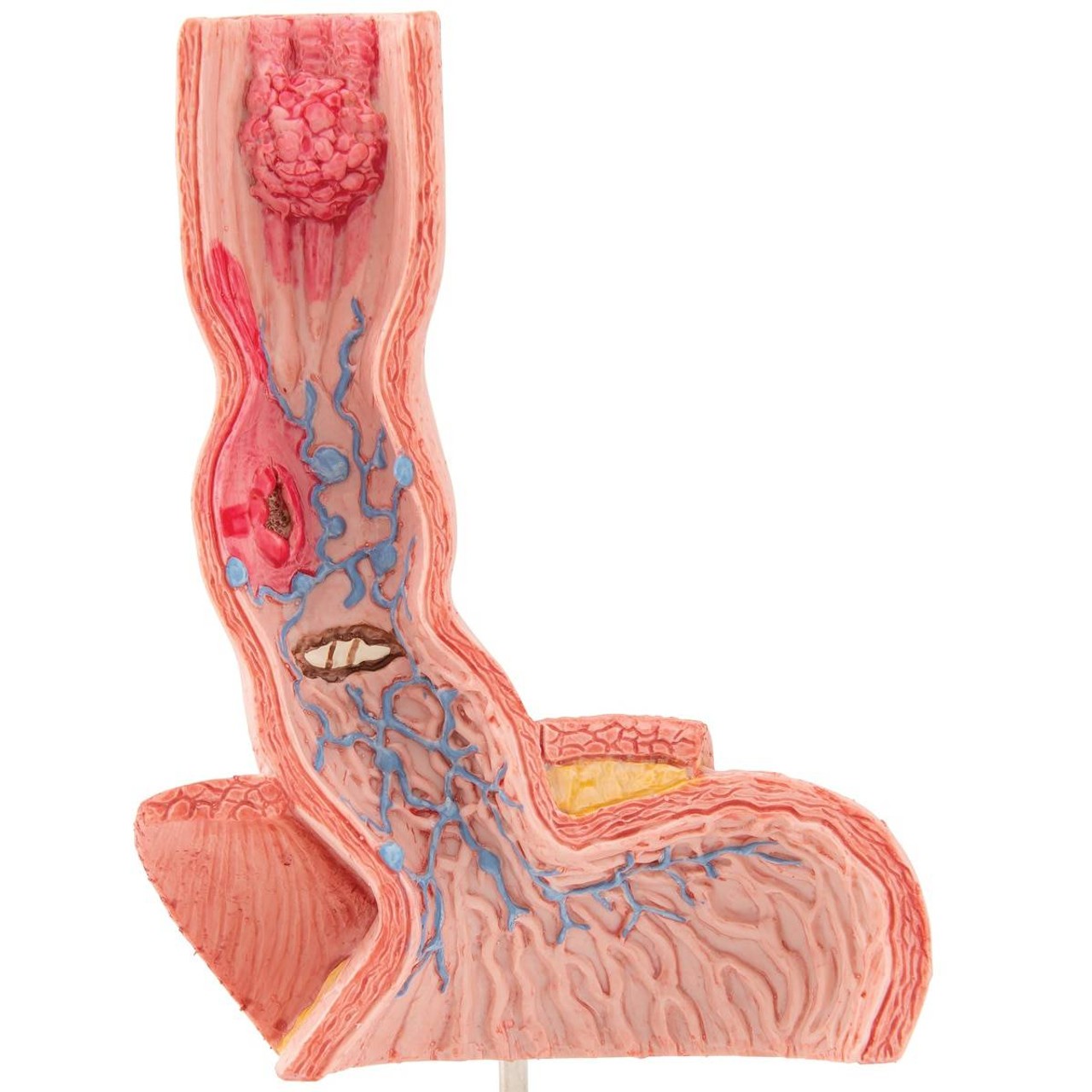 Illnesses Of The Esophagus Anatomy Model