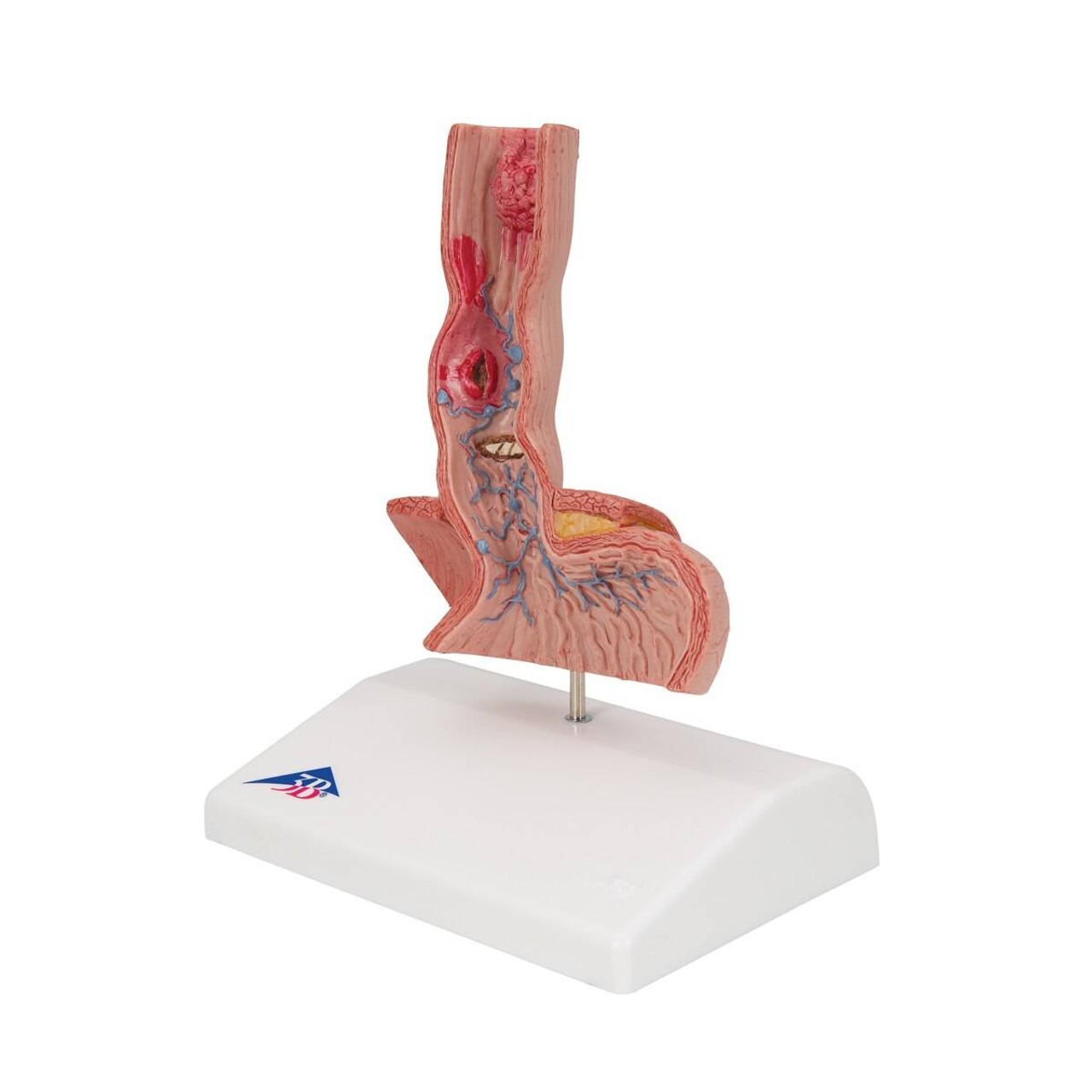 Illnesses Of The Esophagus Anatomy Model