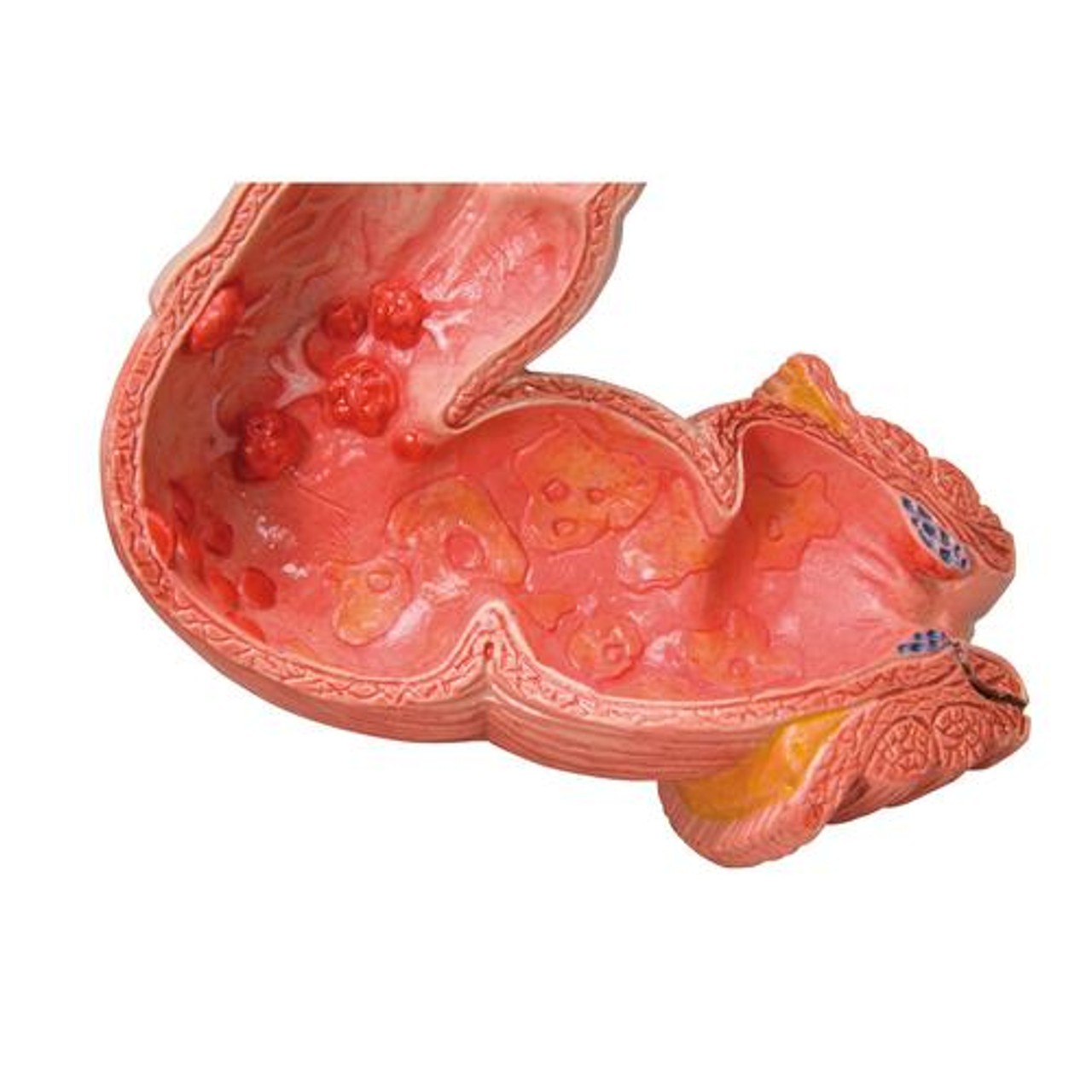 Intestinal Diseases