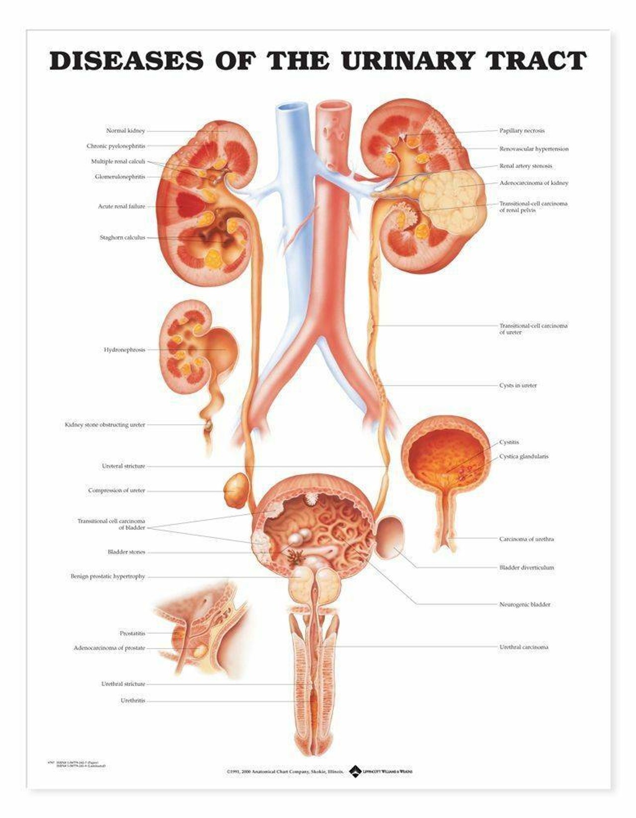 Diseases Of The Urinary Tract Laminated Anatomical Chart