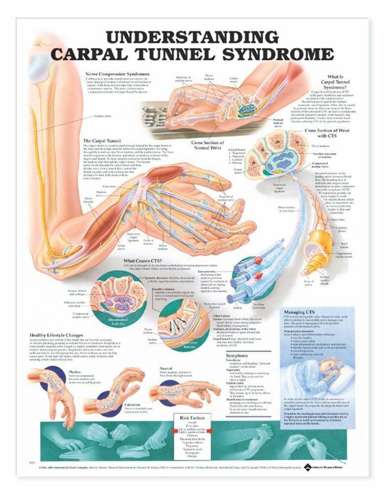 Understanding Carpal Tunnel Syndrome Laminated Anatomical Chart