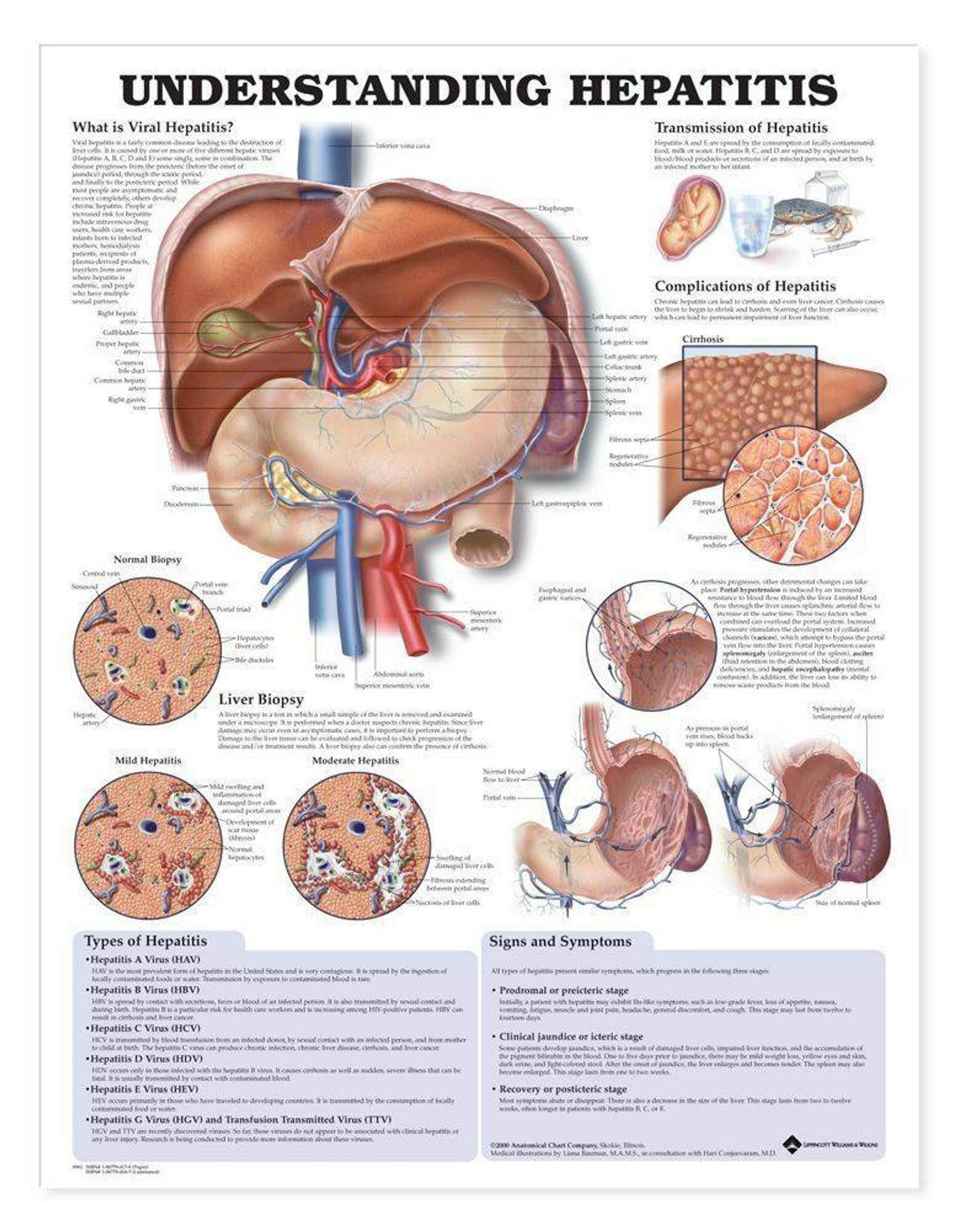 Understanding Hepatitis Laminated Anatomical Chart