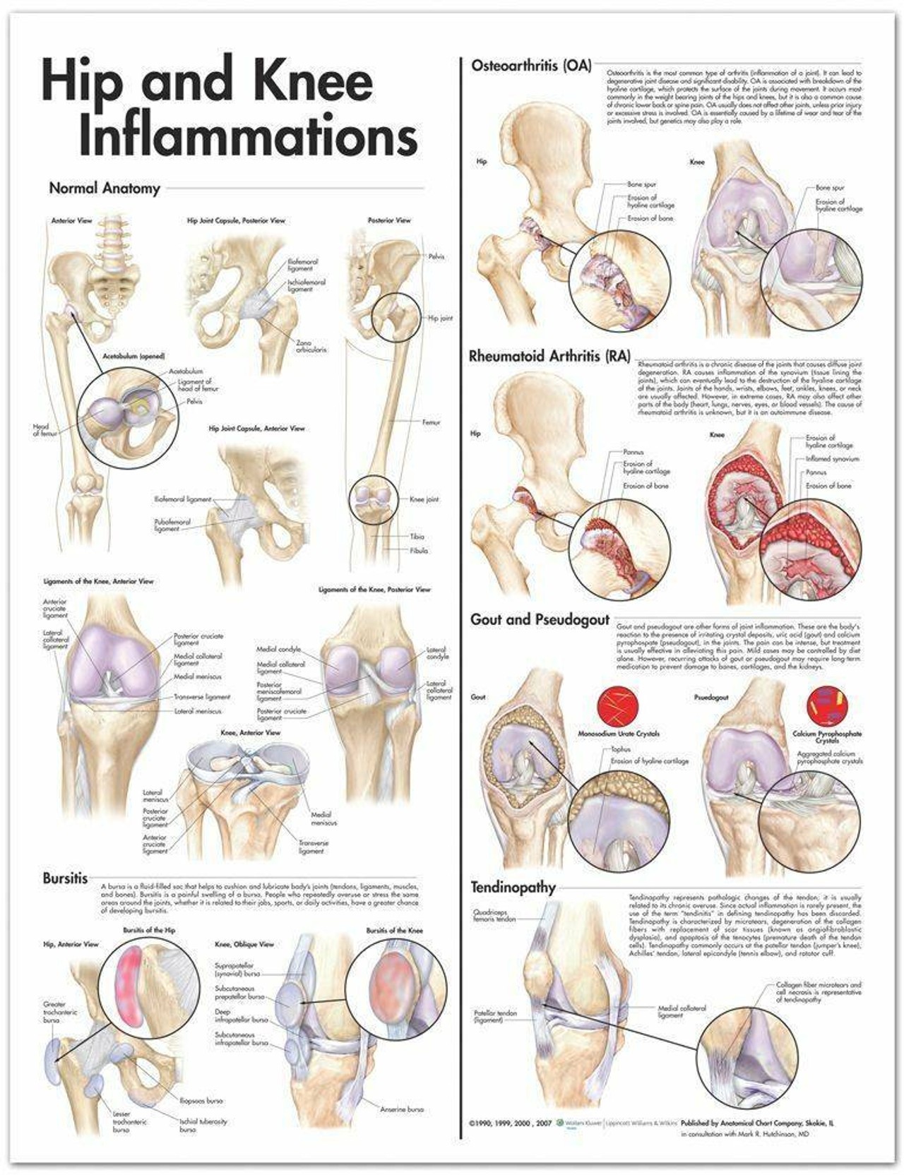 Hip and Knee Inflammations Laminated Anatomical Chart - 2nd Edition