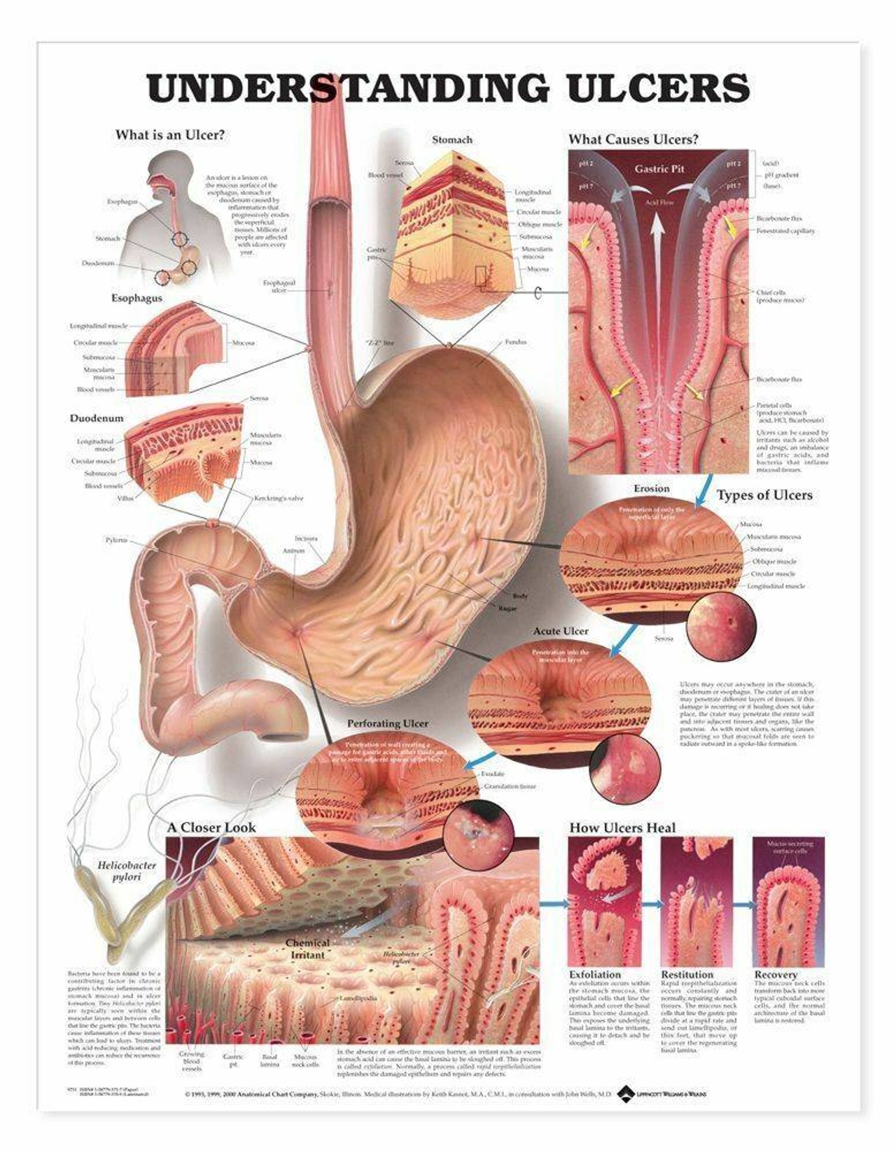 Understanding Ulcers Laminated Anatomical Chart