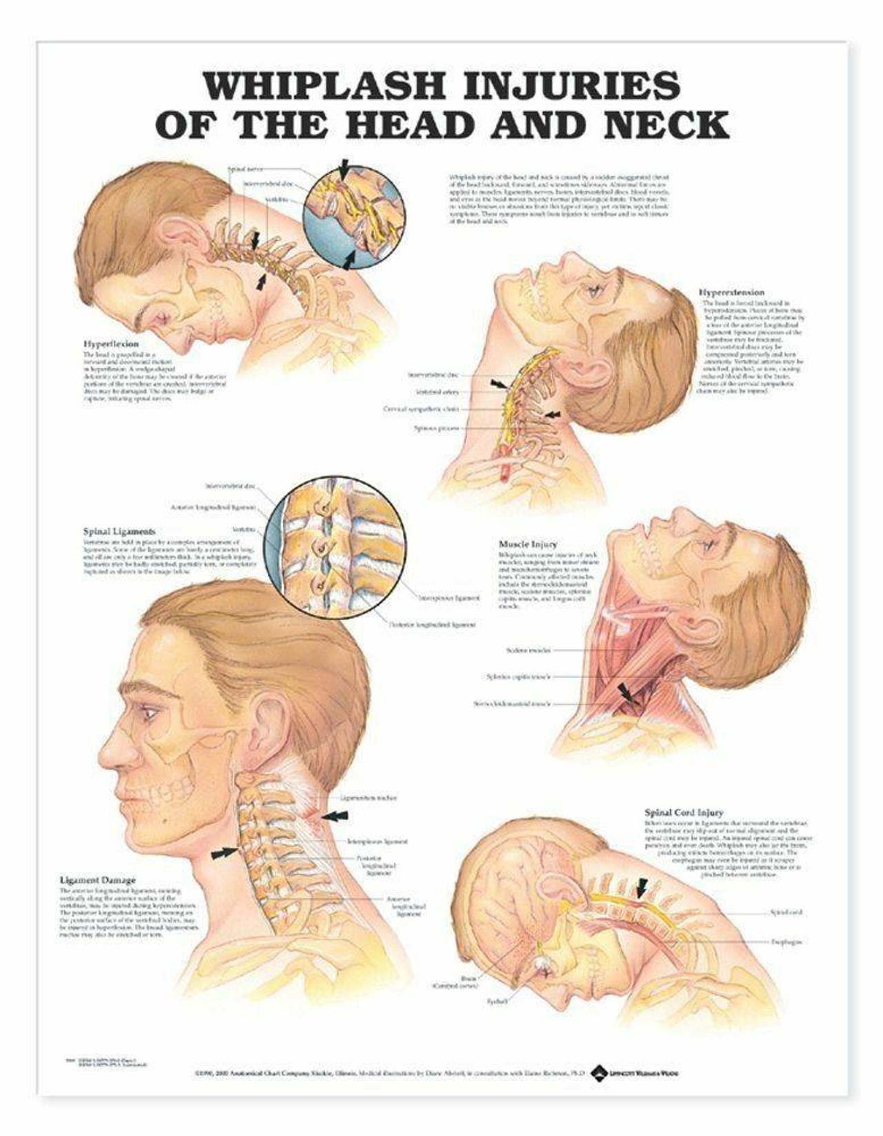 Whiplash Injuries Of The Head and Neck Laminated Anatomical Chart
