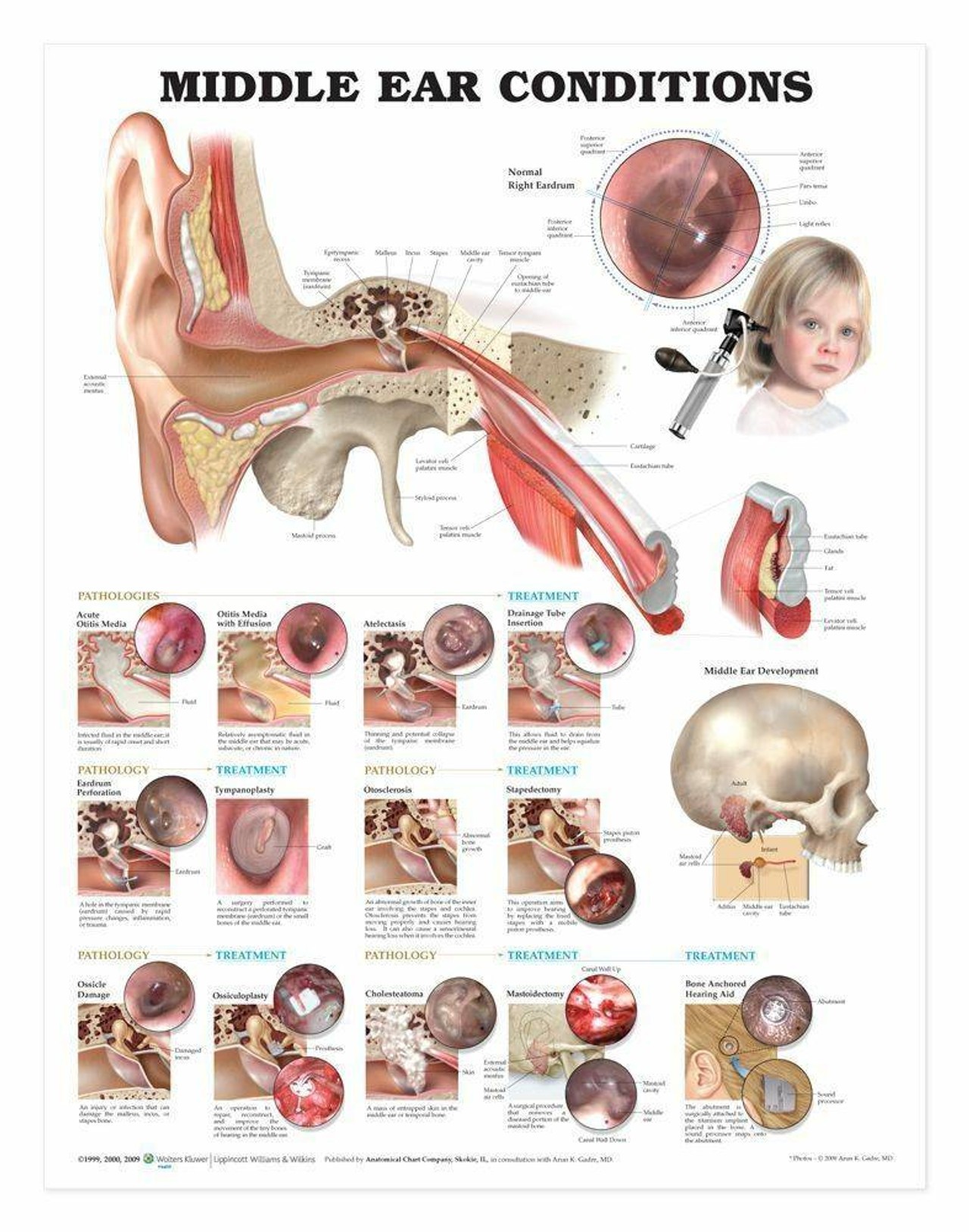 Middle Ear Conditions Laminated Anatomical Chart - 2nd Edition