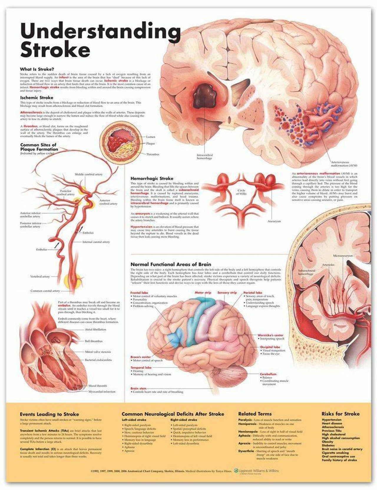 Understanding Stroke Laminated Anatomical Chart - 2nd Edition