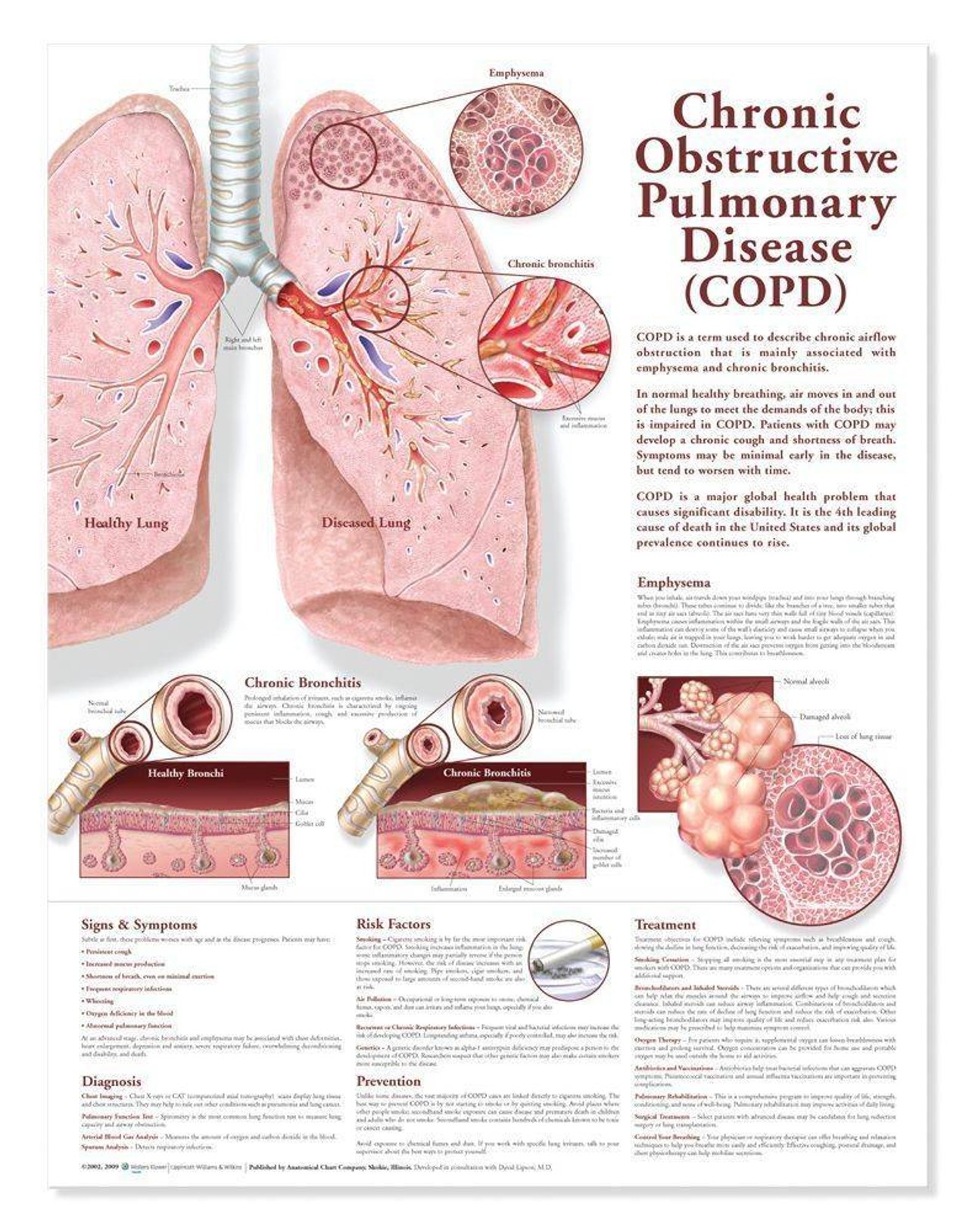 Chronic Obstructive Pulmonary Disease COPD Laminated Anatomical Chart - 2nd Edition
