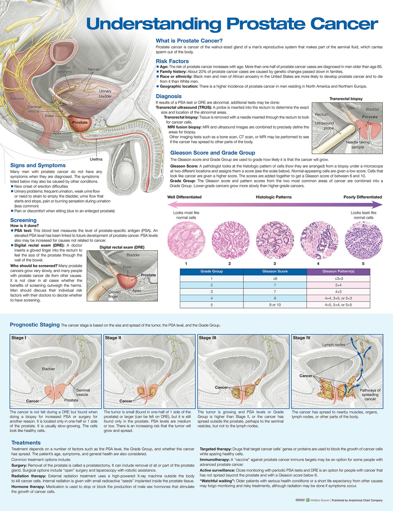 Understanding Prostate Cancer Laminated Chart - 3rd Edition