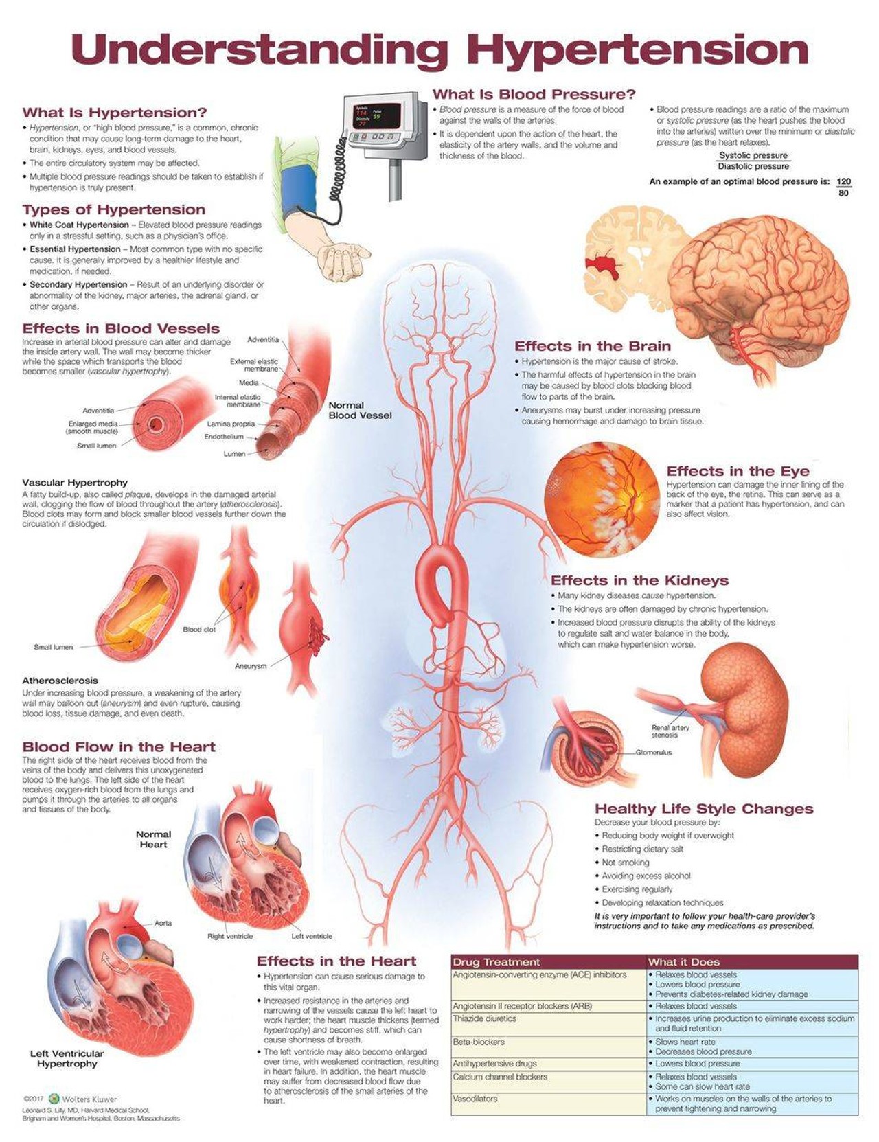 Understanding Hypertension Laminated Anatomical Chart - 2nd Edition