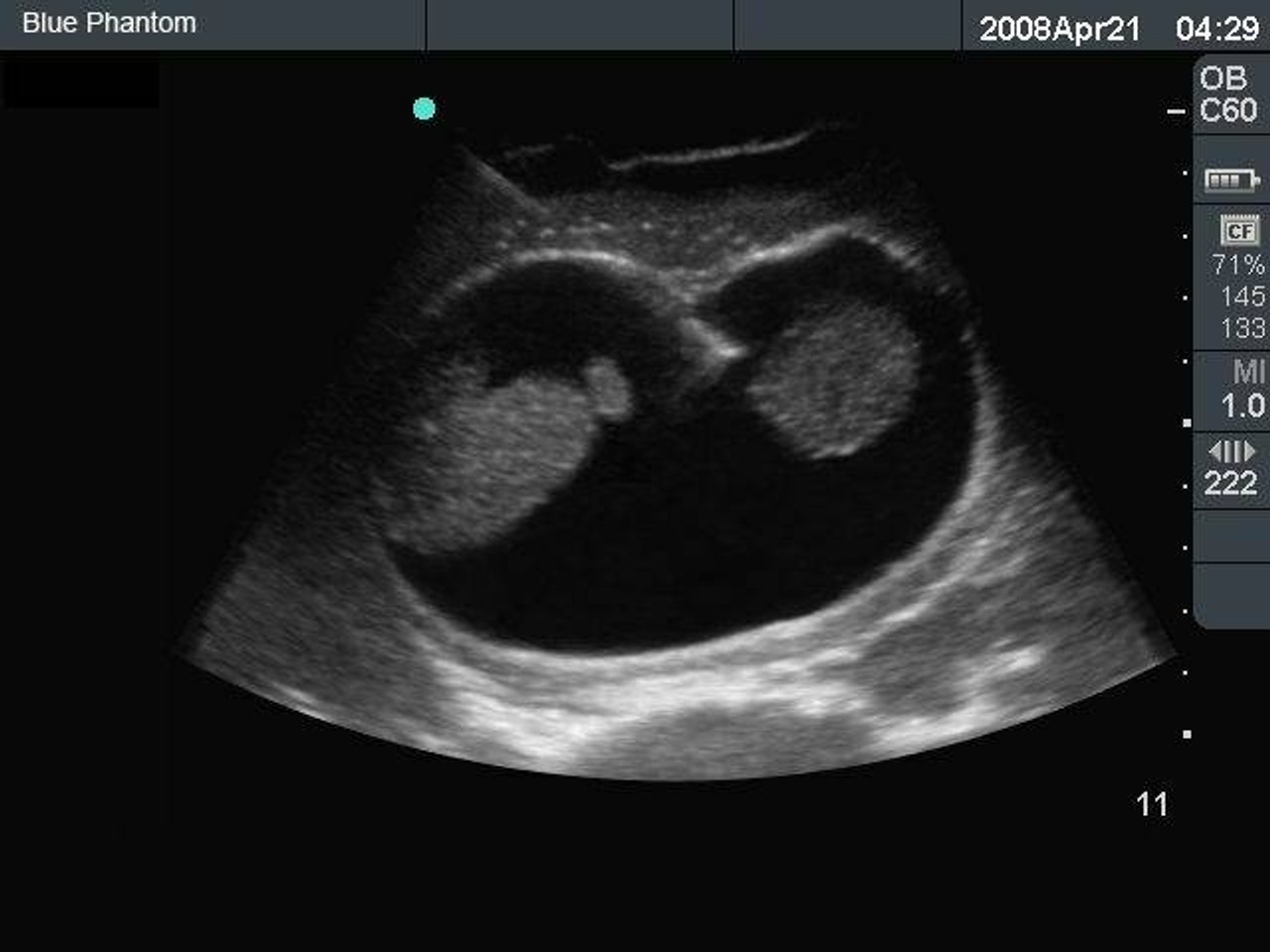 Amniocentesis Ultrasound Training Model
