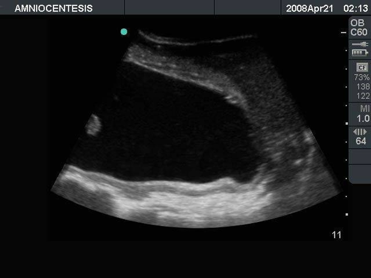 Amniocentesis Ultrasound Training Model
