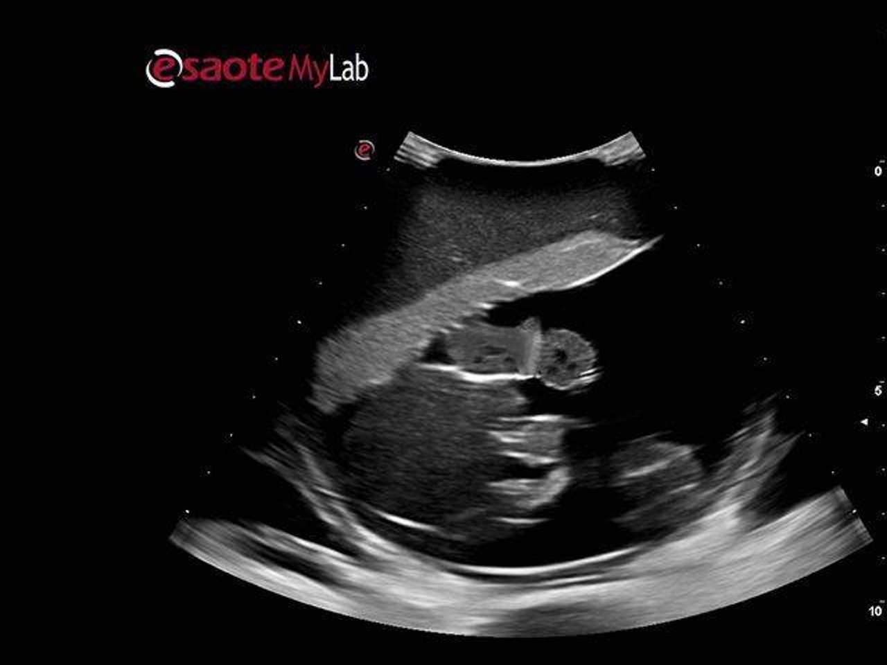 Percutaneous Umbilical Cord Blood Sampling Ultrasound Training Model